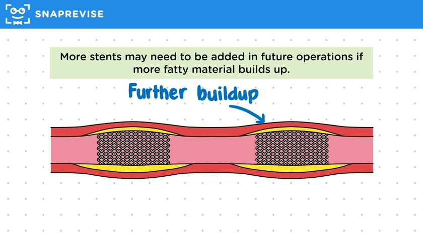 Stents & Statins